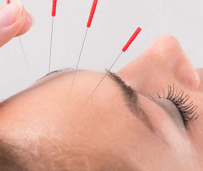 Akupunktur