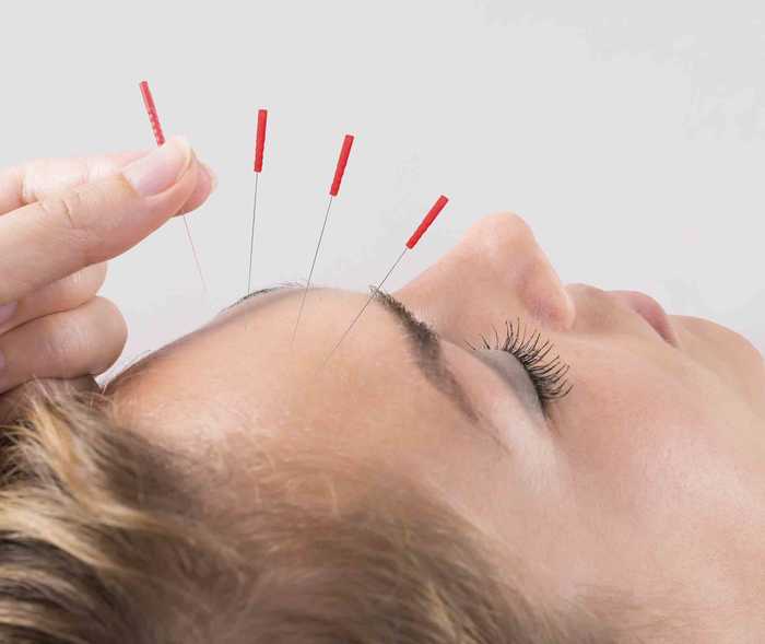 Frau bekommt Akupunktur gegen ihre Migräne.