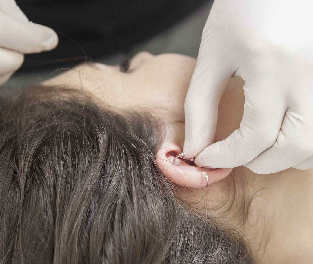 Ein Migräne-Piercing am Ohr soll die Häufigkeit der Schmerzattacken verringern.