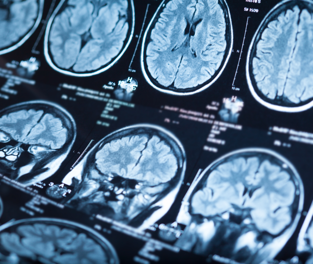 Suche nach Migräne-Ursachen: Röntgenaufnahmen vom Gehirn.